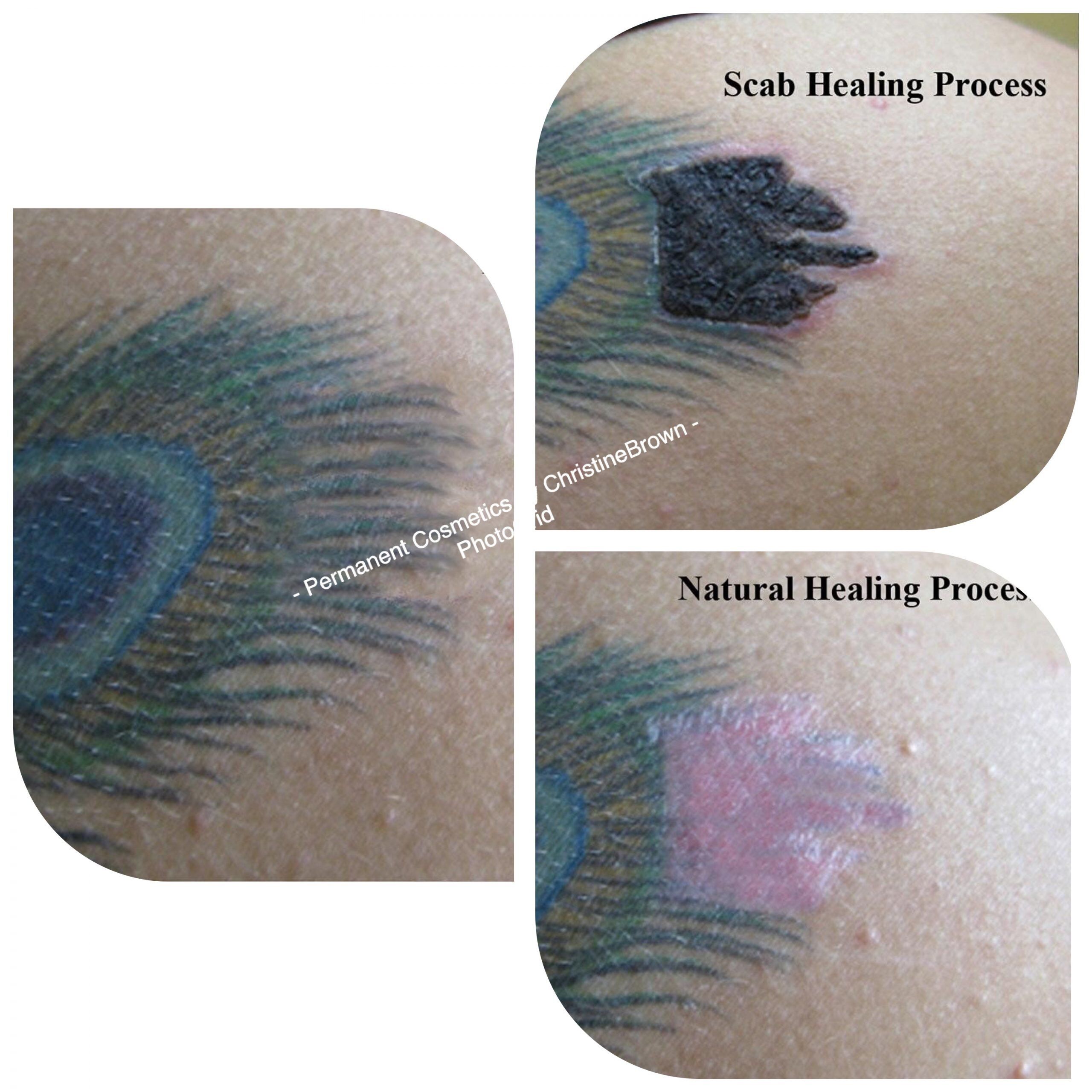 Update more than 64 saline tattoo removal healing process super hot